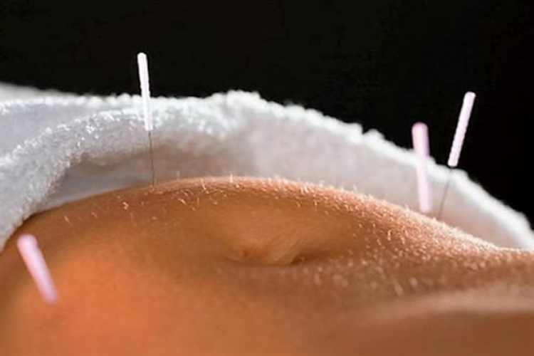 Điện mãng châm điều trị táo bón kéo dài